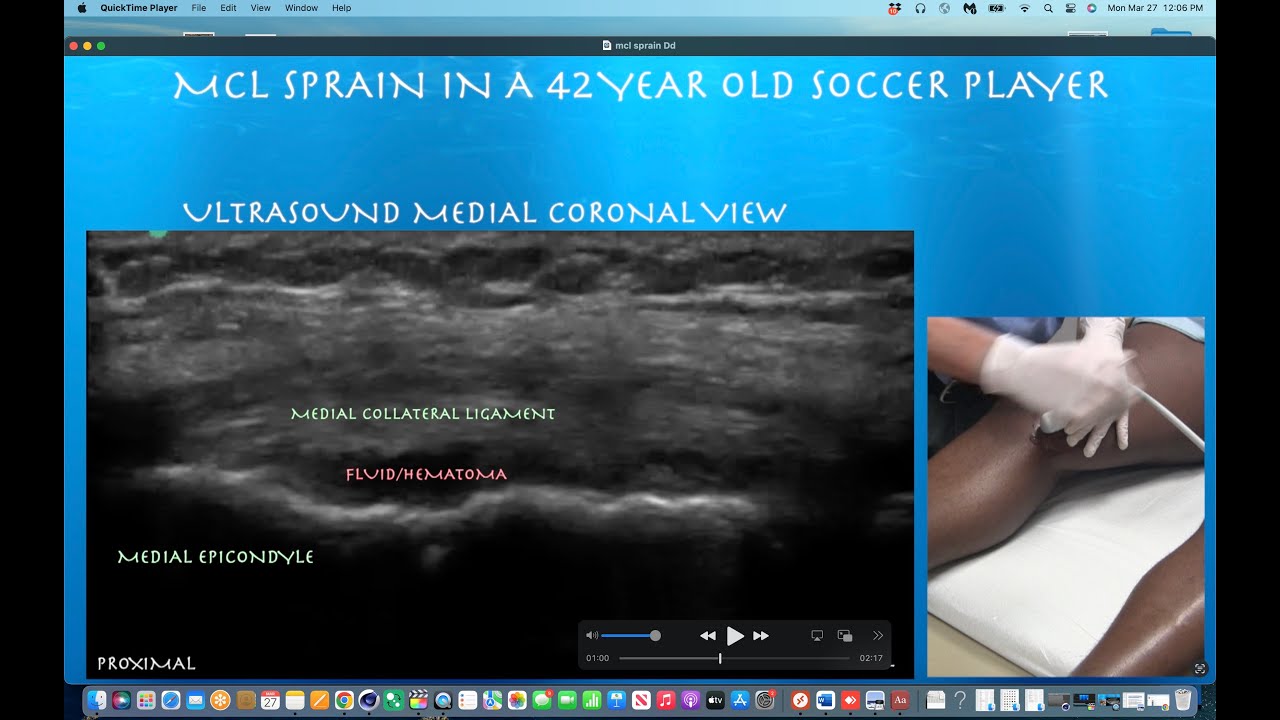 Ultrasound Of Knee MCL Sprain In A 42 Year Old Soccer Player YouTube ultrasound-of-knee-mcl-sprain-in-a-42-year-old-soccer-player-youtube