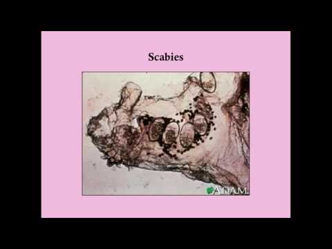 Scabies and Pubic Lice - CRASH! Medical Review Series