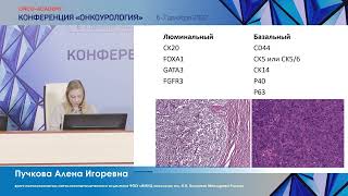 Клинико-морфологическая характеристика молекулярных подтипов уротелиального рака мочевого пузыря.