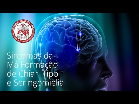 SINTOMAS da Má Formação de Chiari tipo 1 e Seringomielia - Dr Diogo - Neurocirurgião