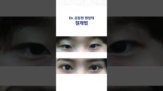 절개법이 쌍수의 꽃인 이유 by 눈성형 레전드