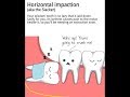 Horizontally Impacted 3rd Molar Extraction - Without Bone Removal