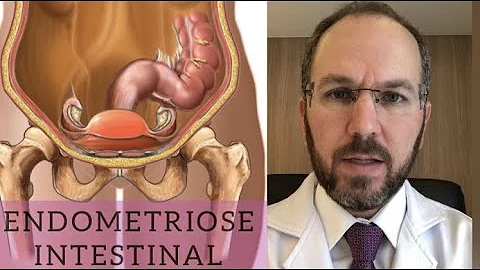 Como são as fezes de quem tem endometriose?
