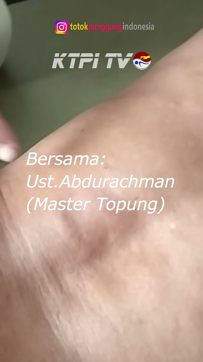 Tip Trik Topung Batu Ginjal #topung #shorts #fyp