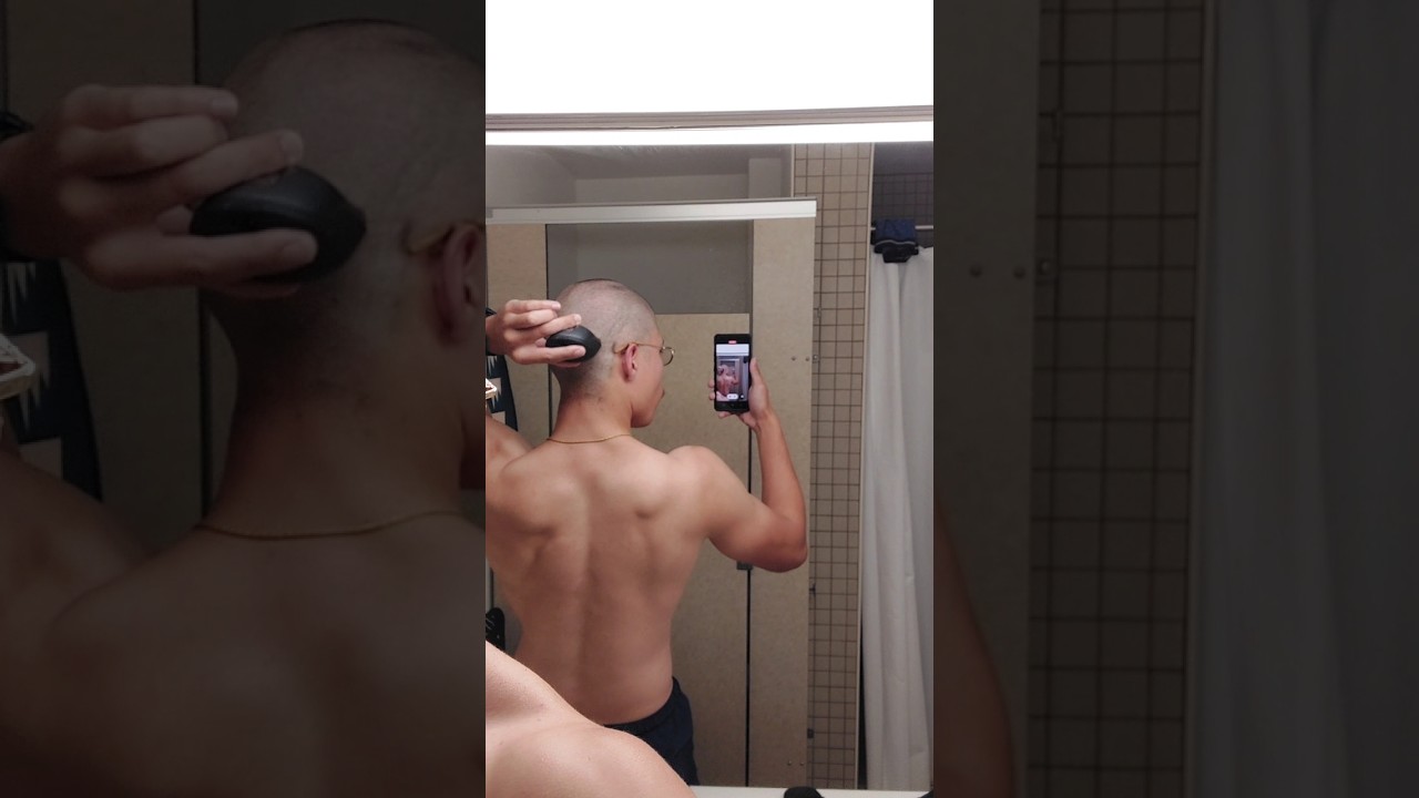 Going bald at 23 (transformation) 