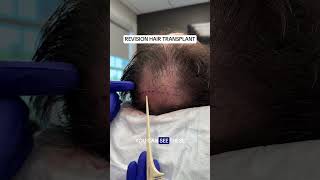 Revision Hair Transplant: Correcting Poor Graft Placement & Low Density #HairRestoration