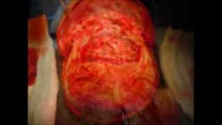 Fronto-Nasal Encephalocele (Encephalocele Of The Anterior Cranial Base) Fronto-Nasal Encephalocele (Encephalocele Of The Anterior Cranial Base)