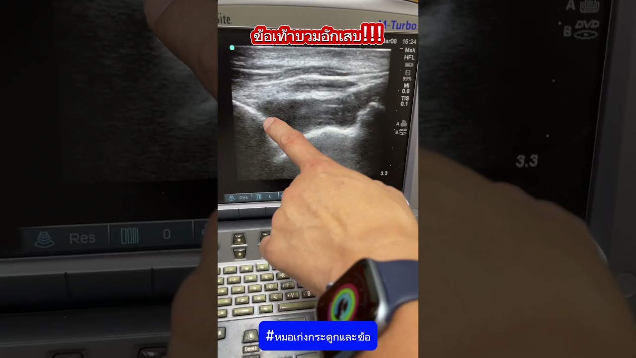 ข้อเท้าบวม อักเสบ รักษา? #หมอเก่งกระดูกและข้อ #ข้ออักเสบ #ข้อเท้าอักเสบ