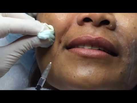 เติมเต็มร่องลึกบนใบหน้าด้วยฟิลเลอร์ @ Siri Clinic