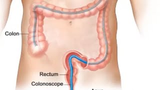 Celebrity Tips to prevent colorectal cancer Net Worth