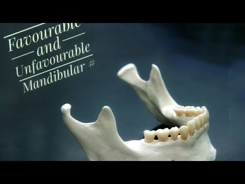 Mandibular Fractures : Favourable and Unfavourable