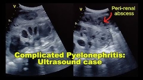 Ultrasound Case: Pyelonephritis with Pyonephrosis & Perirenal Abscess – Real-Time Ultrasound