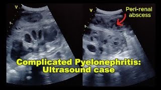 Ultrasound Case: Pyelonephritis with Pyonephrosis & Perirenal Abscess – Real-Time Ultrasound