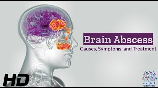 Brain Abscess Unveiled Causes, Symptoms, And Lifesaving Treatments
