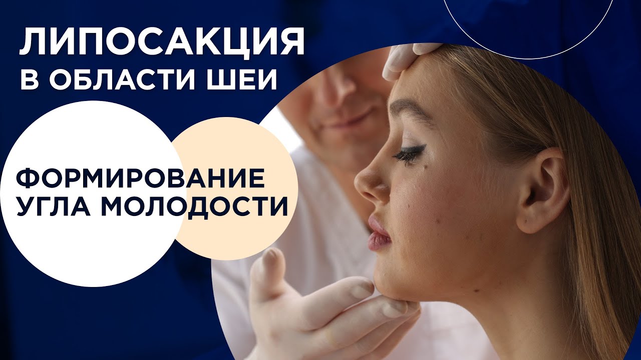 Зыков: Липосакция шеи. Формирование угла молодости на лице. - YouTube