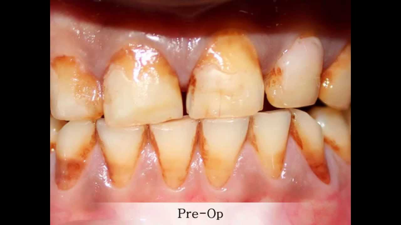 Composite Restorations YouTube