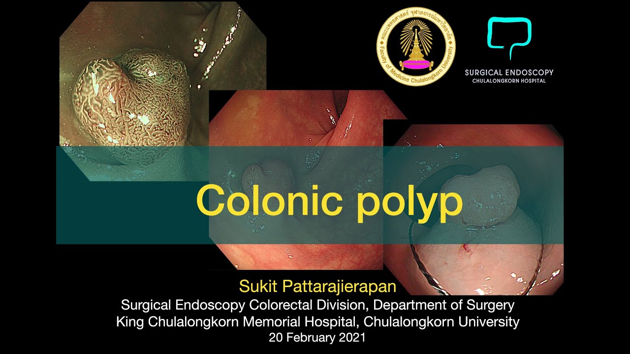 Colonic polyp lecture (Thai language) on Young Colo Surgeon Forum 20-2-2021