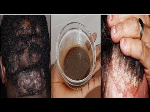 100% Natural Remedies For Scalp  Infections | Inflammation | Alopecia & Massive Hair Growth