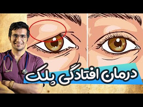 تصویری: چه چیزی باعث می شود پلک های چشم شما کار نکنند؟