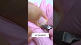 Splinter Tweezers and Ingrown Toenail Nippers by Staleks UK