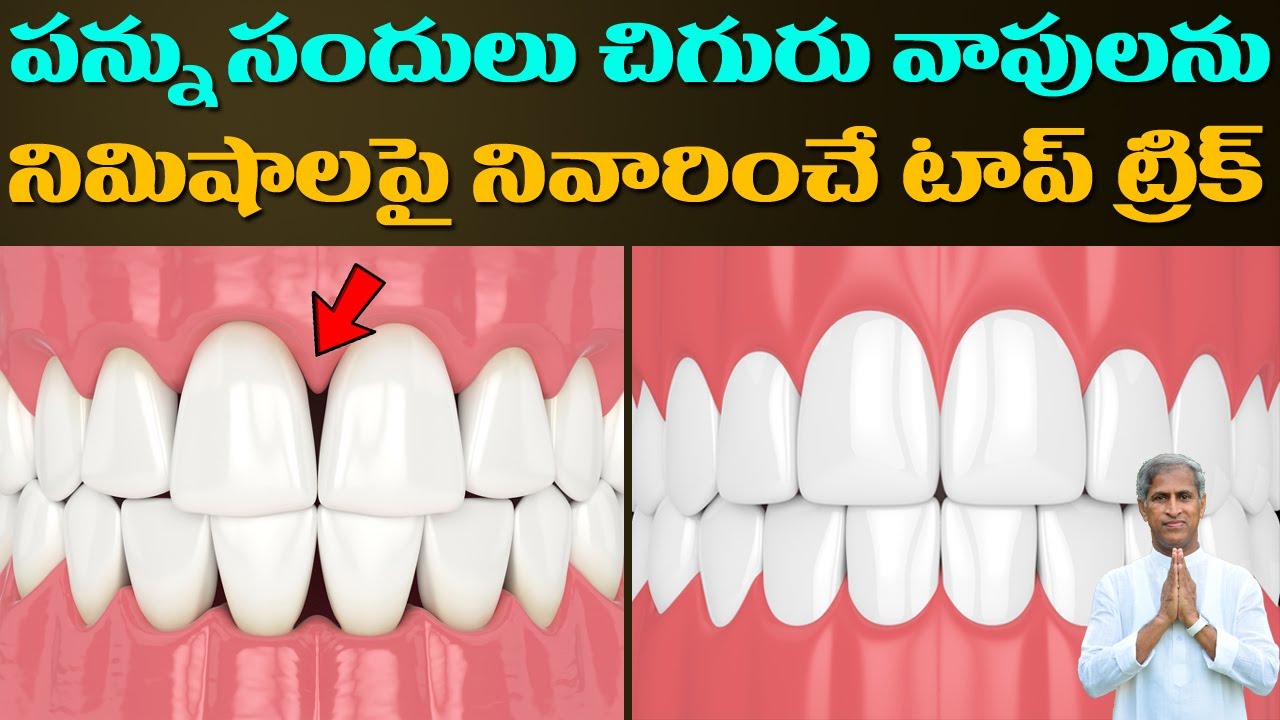 Teeth | పంటి సందులు చిగురు వాపులు నిమిషాల్లో తగ్గిచేస్తుంది | Dr Manthena Satyanarayana Raju