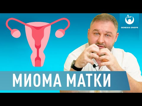 Видео: Какво е субсерозен лейомиом на матката?