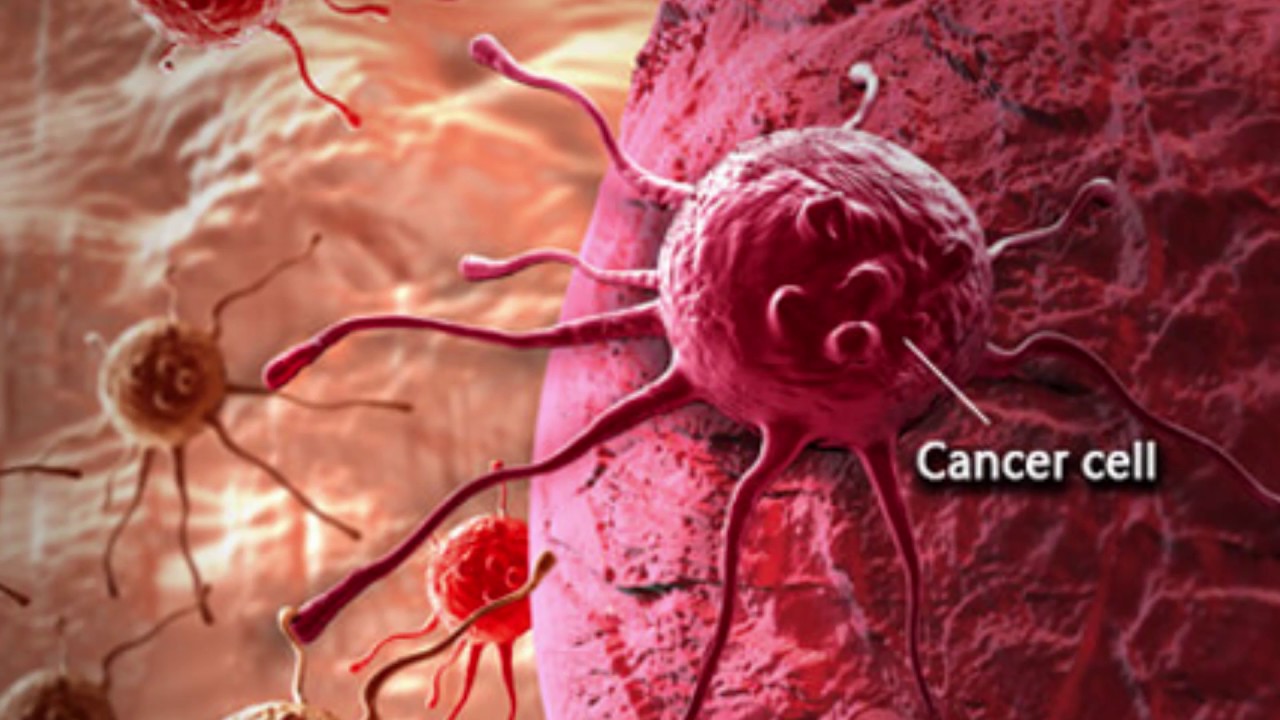 Cancer de colon y emociones, Cancer de colon bioneuroemocion - granturieuropene.ro