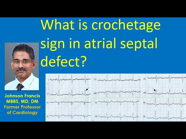 What is crochetage sign in atrial septal defect? 