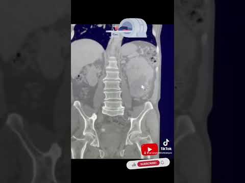 Vídeo: El càncer de pròstata apareixeria en una tomografia?