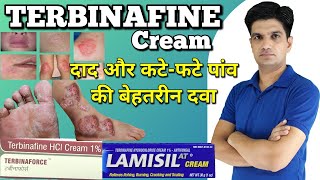Terbinafine cream | Terbinaforce cream | Terbinafine hydrochloride cream