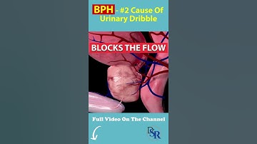 Thumbnail of The #2 Cause Of Urinary Dribble