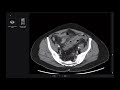 Introduction to abdominal ct