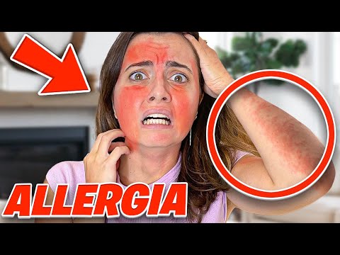 Video: Ho avuto una reazione allergica?