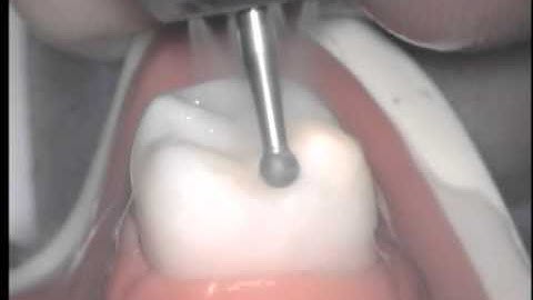 06 Occlusal Rest Seats