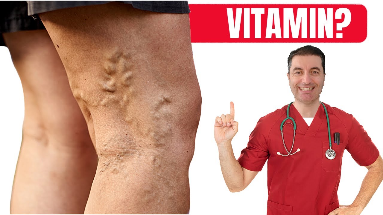 ВИТАМИН №1 для профилактики варикозного расширения вен