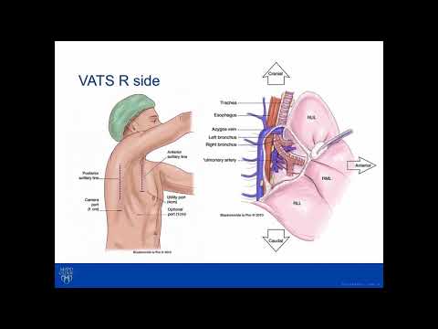 Video: Lobektomi: Definition Og Patientuddannelse