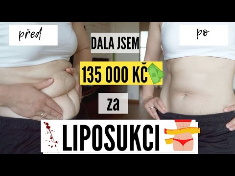 Video: Nechirurgická Liposukce - Recenze, Typy, Indikace