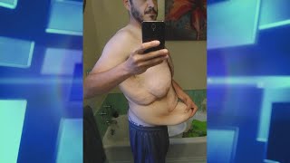 Surgery Surprise for Man Who Lost Half His Body Weight