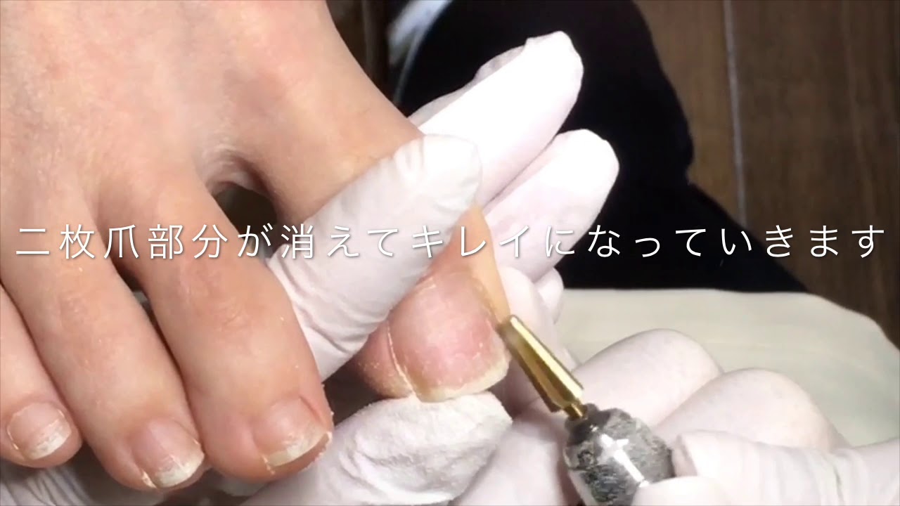 うろこ状の二枚爪をきれいに整える 群馬巻き爪ケアセンター Youtube