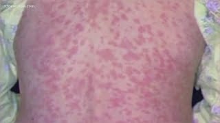 Measles may be spreading more widely than first thought, research shows