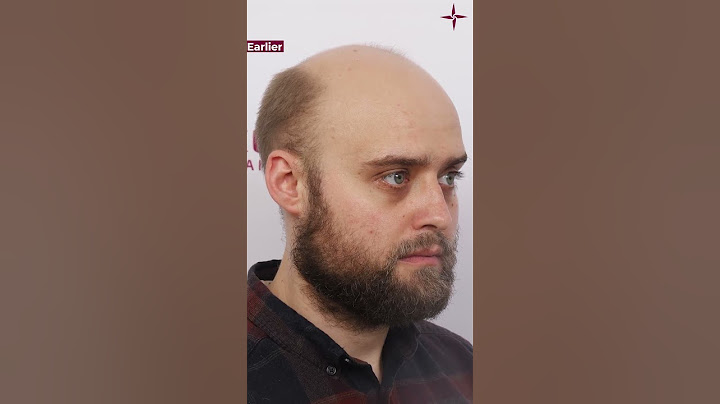 Inspirativní výsledky transplantace vlasů: Cesta ze Spojeného království do Eugenix!