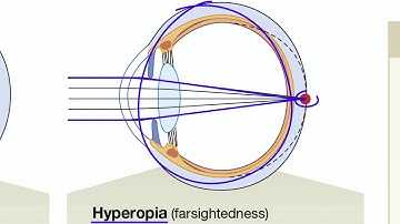 Light Refraction and Focused Vision in the Eye