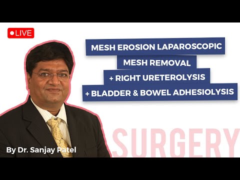 Mesh Erosion Laparoscopic Mesh Removal + Right Ureterolysis + Bladder & Bowel Adhesiolysis