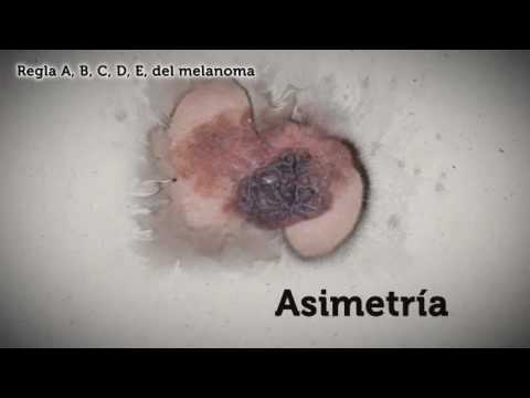 Vídeo: Etapas Del Melanoma: Pruebas De Diagnóstico Y Opciones De Tratamiento