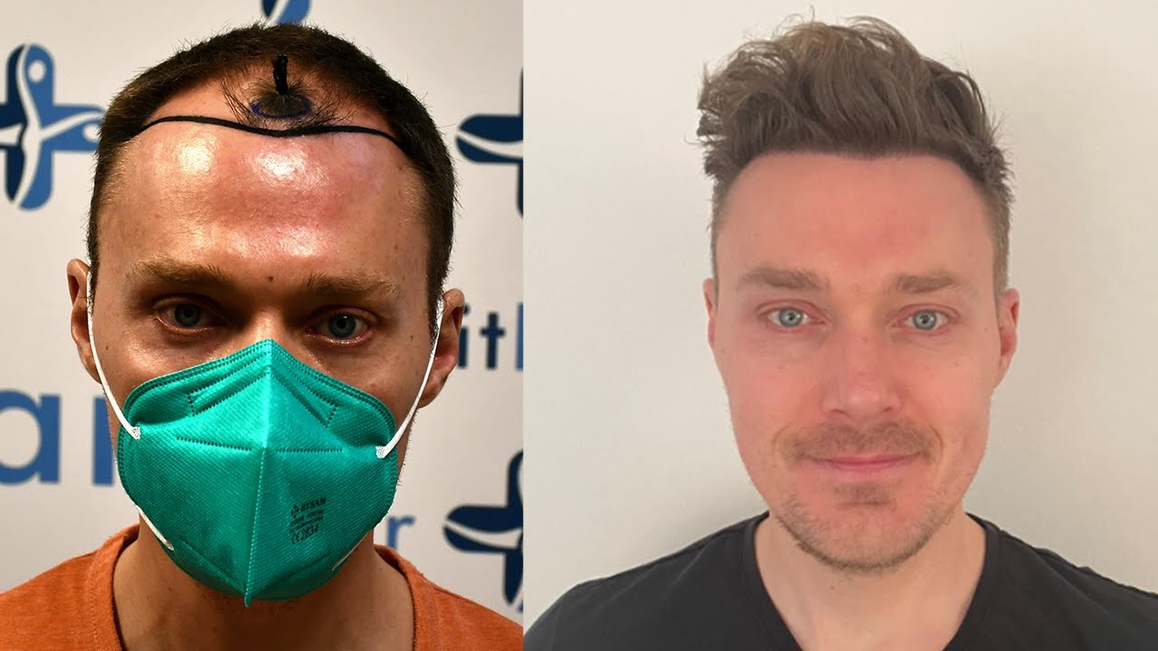 Trapianto di capelli prima e dopo in avanzamento rapido