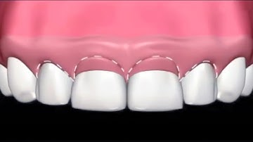 Gummy smile treatment | Điều trị cười hở lợi