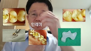 레진 /  인레이  / 크라운 치과치료 정리