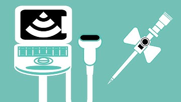 Ultra Sound Guided Cannulation