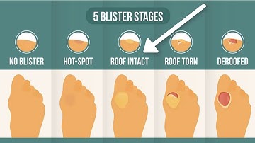 How To Treat A Blister Correctly (First, Look At Your Blister Roof)