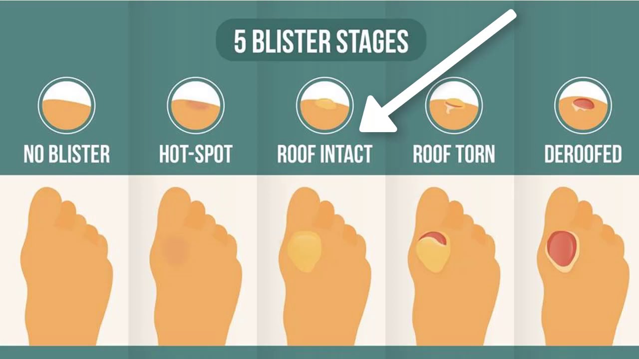 How To Treat A Blister Correctly (First, Look At Your Blister Roof) -  YouTube